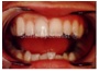 SmileSpecialist Tooth Veneers that look natural